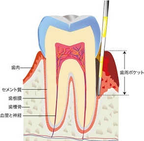 歯周ポケット.jpg